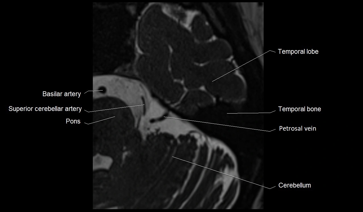 Internal auditory canal (IAC) axial cross sectional anatomy image 32.webp